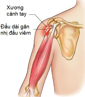 biceps tendonitis